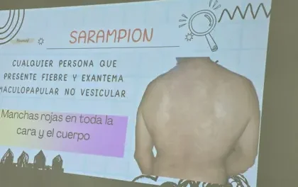Suben a 14 los casos de sarampión en Santa Cruz; seis hermanos no vacunados, son los últimos afectados