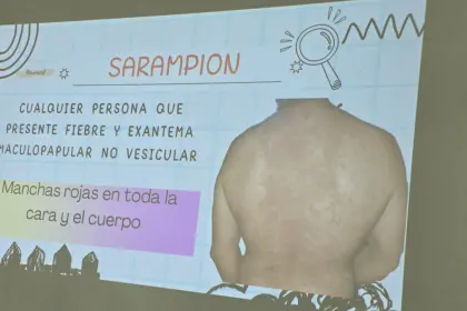 Suben a 14 los casos de sarampión en Santa Cruz; seis hermanos no vacunados, son los últimos afectados