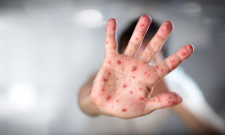 El sarampión se expande ante la baja cobertura de vacunación en niños
