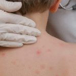 Niño de cuatro años, tercer caso de sarampión en Cochabamba